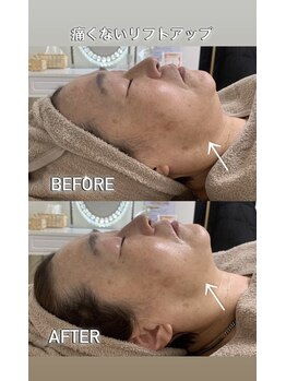ニコ(25)/痛みの少ないリフトアップ♪