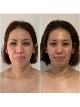 サロンメロウ 大牟田店(salon mellow)/【完全オーダーメイド】小顔矯正