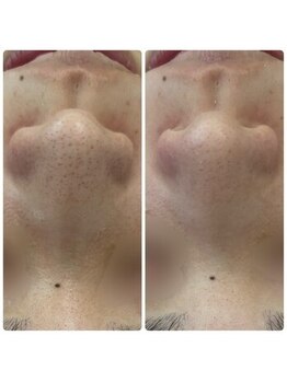 ファーファラ(Farfalla)/毛穴洗浄×水光ピール