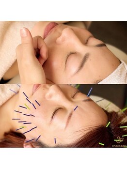 チョコバリ 郡山店(chocobari)/小顔×育毛ダブル【美容鍼】