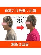 ララ鍼灸サロン(LaLa鍼灸サロン)/首肩こり改善するだけで小顔に