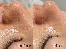 ルアナ(LUANA)/ララピール×毛穴洗浄