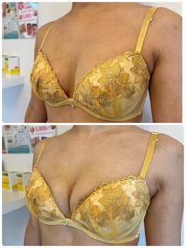 美人バスト 本厚木店/バストアップ◇症例◇