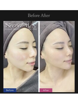 アルビ(ARuBi)/炭酸パックでいちご鼻サヨウナラ