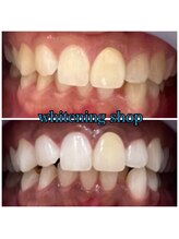 ホワイトニングショップ 武蔵小杉店/武蔵小杉ホワイトニング美白ケア