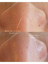 オニュ(onyu)/毛穴詰まりも解決！