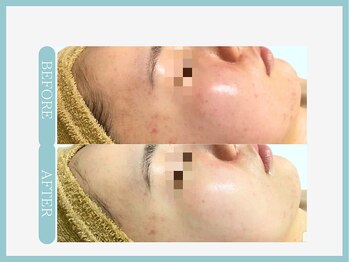 アコガレコガオ 山形店/