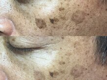 エミュ(emu)/そのシミ諦めるにはまだ早い