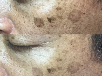 エミュ(emu)/そのシミ諦めるにはまだ早い