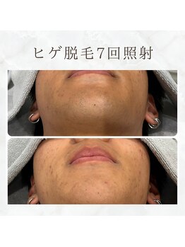 ボゴス 天白店(BOGOSS)/【ヒゲ脱毛】施術写真
