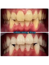 ホワイトニングショップ 武蔵小杉店/武蔵小杉ホワイトニング美白ケア