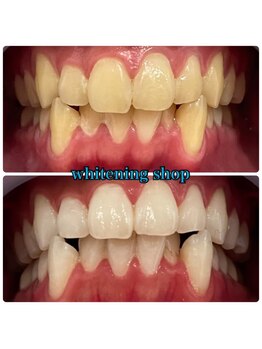 ホワイトニングショップ 武蔵小杉店/武蔵小杉ホワイトニング美白ケア