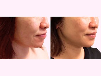 ぷるるんエステの写真/1回で変化を実感できる土台から整える根本小顔矯正×美容外科の施術相談も叶う湘南唯一の提携サロン