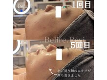 ベリールルヴィ(..Belire.Revi)の雰囲気（ハーブピーリングの1回目と5回目のBefore After☆）