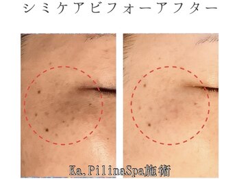 カピリナスパ(Ka.Pilina Spa)/シミケア1回目 before⇒after