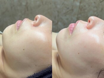 エモーショナル 姫路(Emotional)/ララピール×LDM10回の変化