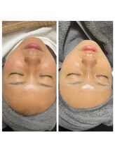 レミリー(Lemiry)/毛穴ケア陶肌ピール