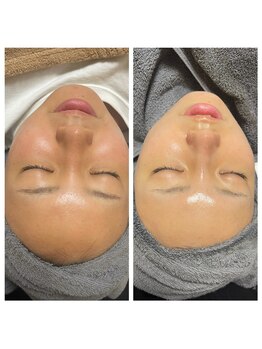 レミリー(Lemiry)/毛穴ケア陶肌ピール