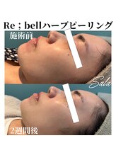 サラ/ハーブピーリング