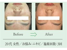 エステプロ ラボ 自由が丘/Before→After