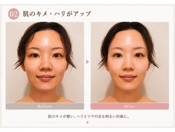 モアフェイス 池袋店(More Face)/たるみ・肌ツヤ・フェイスライン