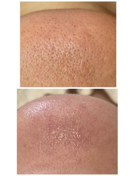 シェルビー(Cielbe.)/毛穴エクストラクション