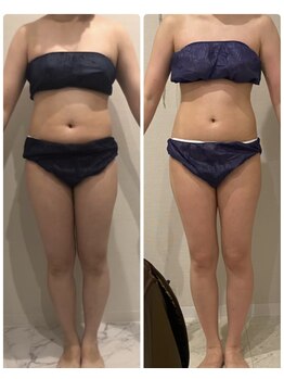 エステサロン ブレス 山形店(BLESS)/痩身結果