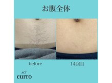 アクト クロ(ACT curro)/【お腹全体】脱毛施術例