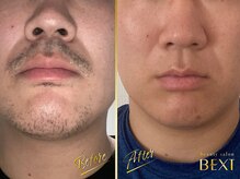 ベクスト(BEXT)/ヒゲ脱毛(PRO) 