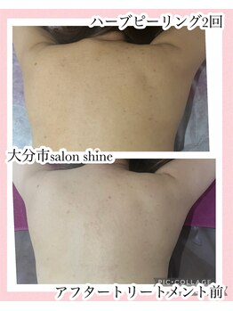 サロンシャイン(Salon Shine)/ハードタイプ ハーブピーリング