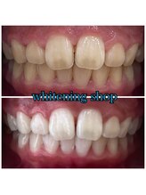 ホワイトニングショップ 武蔵小杉店/武蔵小杉ホワイトニング美白ケア