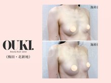 オウキ 梅田北新地(OUKI.)/バストアップ結果写真