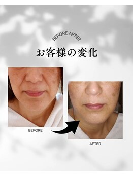 グラシア(gracia)の写真/ほうれい線・たるみ改善！予防ケア