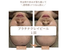 メグル(MEGURU)の雰囲気（プラチナクレイピール1回　メラミースキンケアデイリー使用◎）