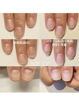 ニコプラス(NICO+)/自爪育成中
