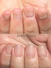 マリーロール 淀屋橋本店(Marie Laure)/自爪育成/深爪矯正/ネイルケア