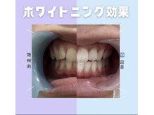 エヌエーホワイトニング たまプラーザ店(NAホワイトニング)/【before/after】20代女性