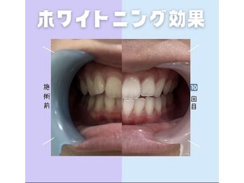 エヌエーホワイトニング たまプラーザ店(NAホワイトニング)/【before/after】20代女性