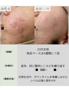 サロンエヌ 久留米店(Salon N)/慢性的な肌荒れ改善