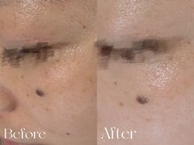 ウィハナ(wehana)/【セラピール】目元のシワたるみ