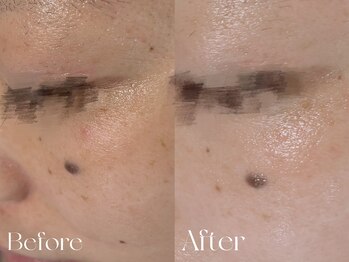 ウィハナ(wehana)/【セラピール】目元のシワたるみ