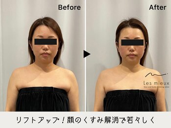 レミュー(Les mieux)/たった１回で引き締まった顔に！