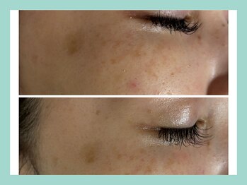 ミウル 天王寺店(miulu)/シミ照射