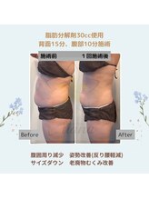 ルアナ(Luana)/脂肪分解＆燃焼！引き締めケア