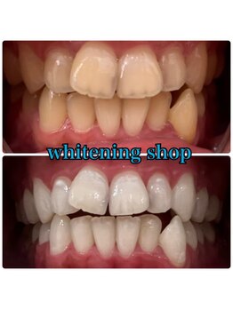 ホワイトニングショップ 武蔵小杉店/武蔵小杉ホワイトニング美白ケア