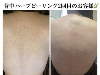 ビエストラ(Biestora)/背中ハーブピーリング2回目