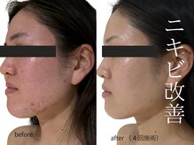 セン(Senn.)の雰囲気（"対処"ではなく肌質改善プログラムマーメイドセルトリートメント）