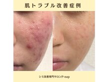 ピーナップ(P-nap)の雰囲気(低刺激のwax脱毛でつるつるお肌に◎)