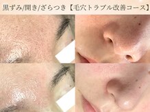 エミルカ 仙台(EMILUCA)の雰囲気（長年苦しんだ毛穴悩みから解放！全顔ケアでつるんと毛穴美人に！）