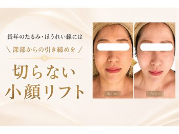 エン 橿原店(en)の写真/お悩みの原因を見極め、筋肉×脂肪へWアプローチする医療級のたるみケア。若々しいフェイスラインへ。
